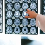 What is a Brain Stroke